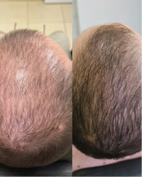 Couro cabeludo antes e depois da camuflagem capilar, lado a lado, com falhas disfarçadas